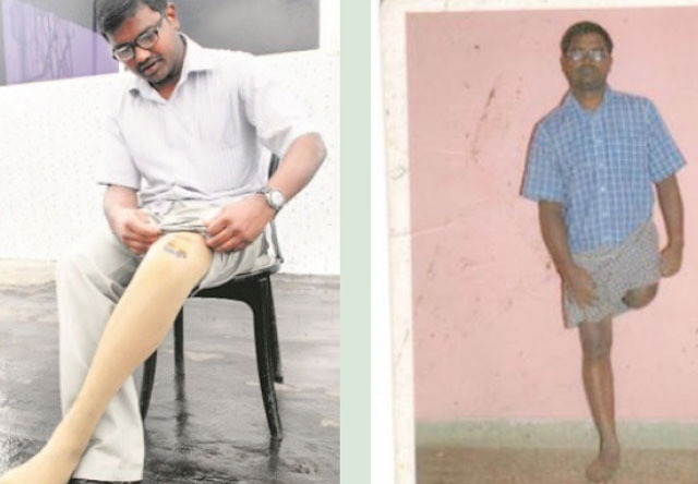 Help Babu from Bengaluru who has Requested monetary support for replacement of his knee joint. Your Generous help will be a great help to Babu. 